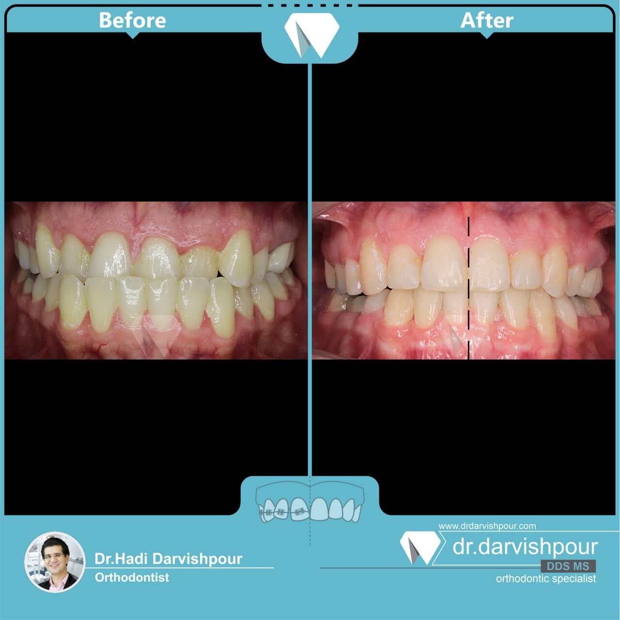 1753orthodontics-before-after-photo