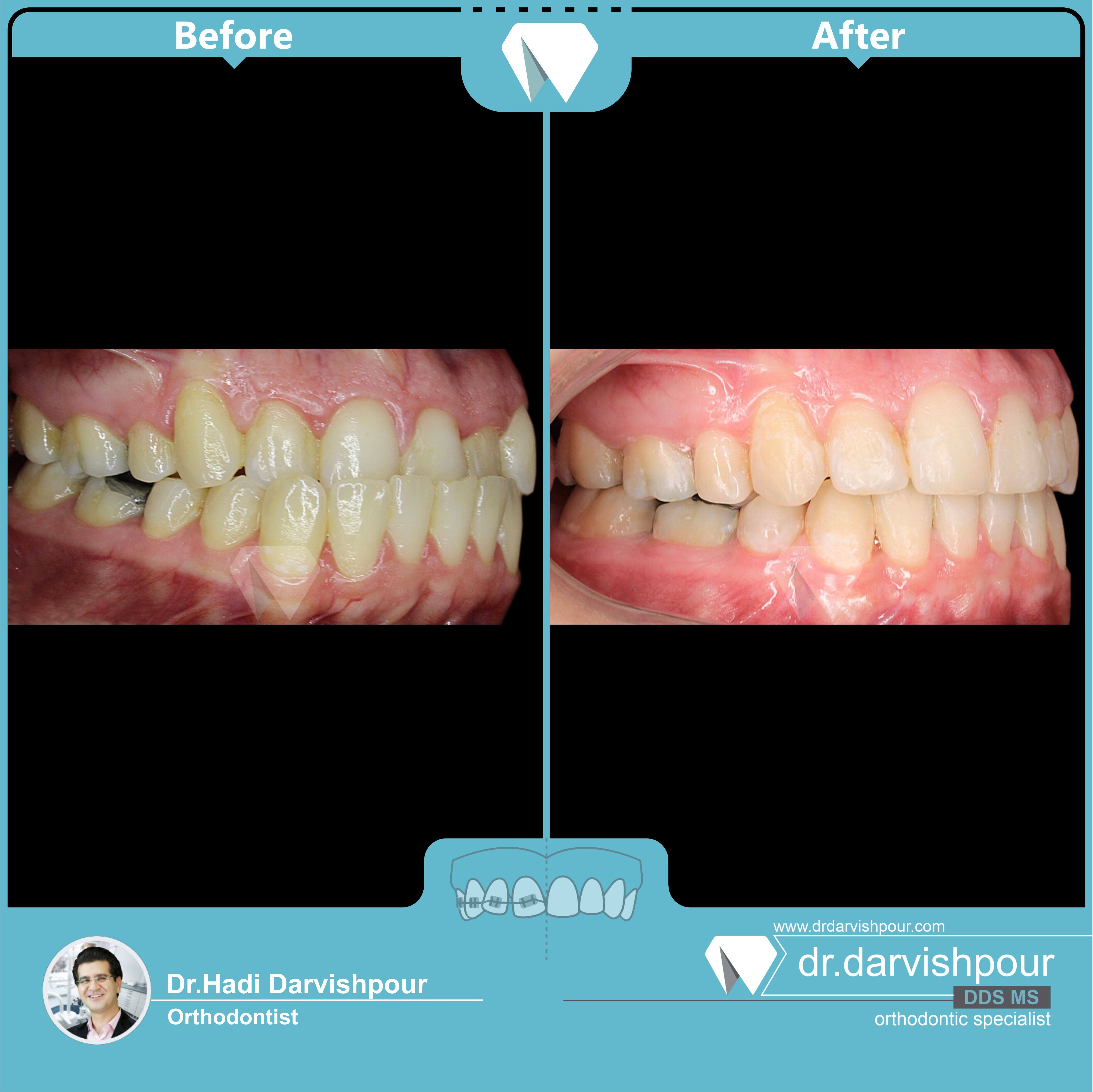 1754orthodontics-before-after-photo