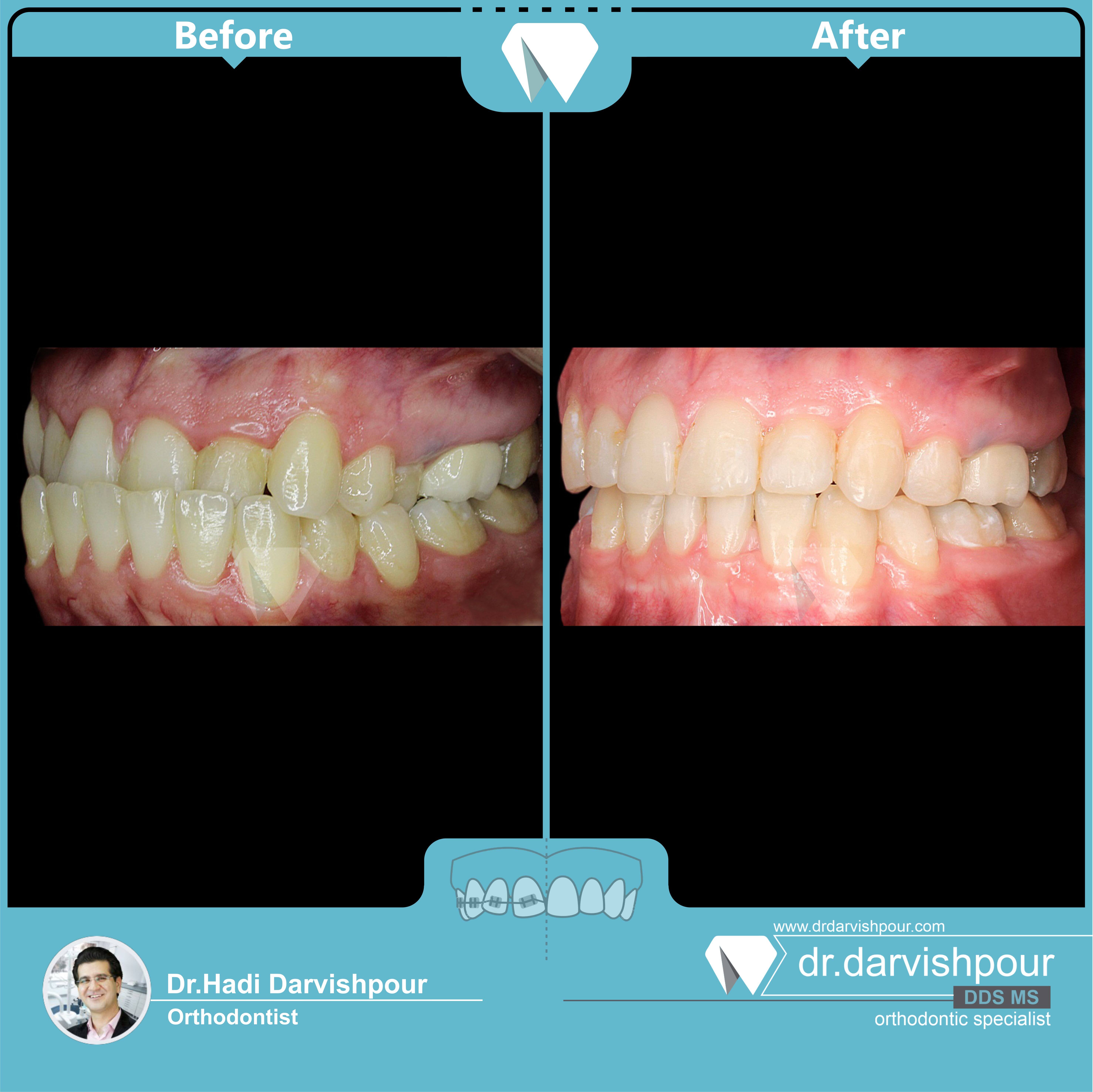 1755orthodontics-before-after-photo