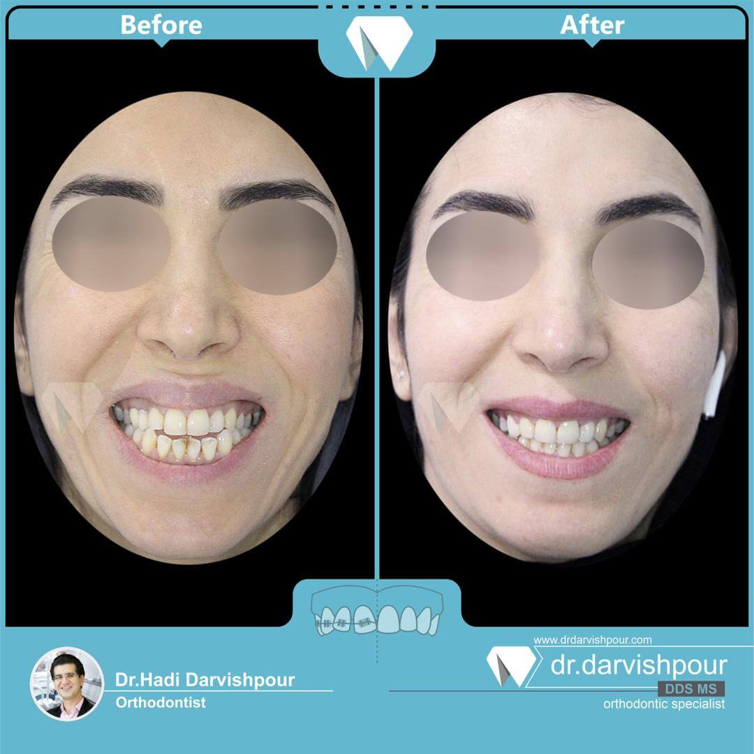 1759orthodontics-before-after-photo