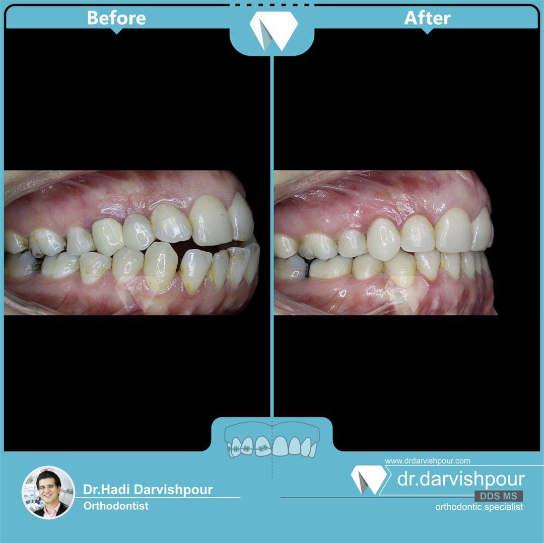 1760orthodontics-before-after-photo