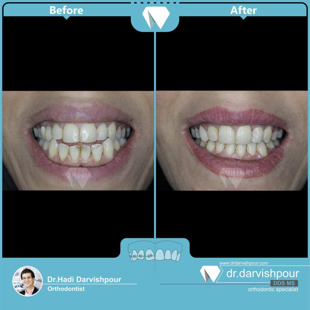 1761orthodontics-before-after-photo