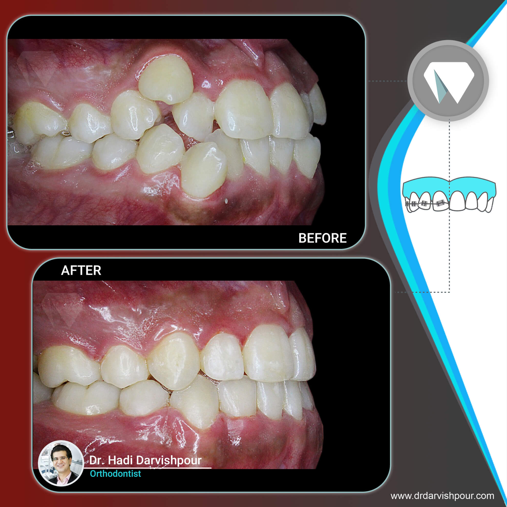 1765orthodontics-before-after-photo