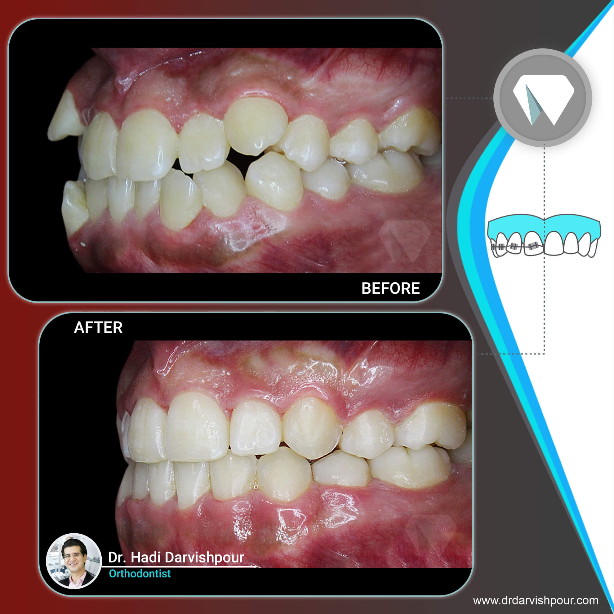 1766orthodontics-before-after-photo
