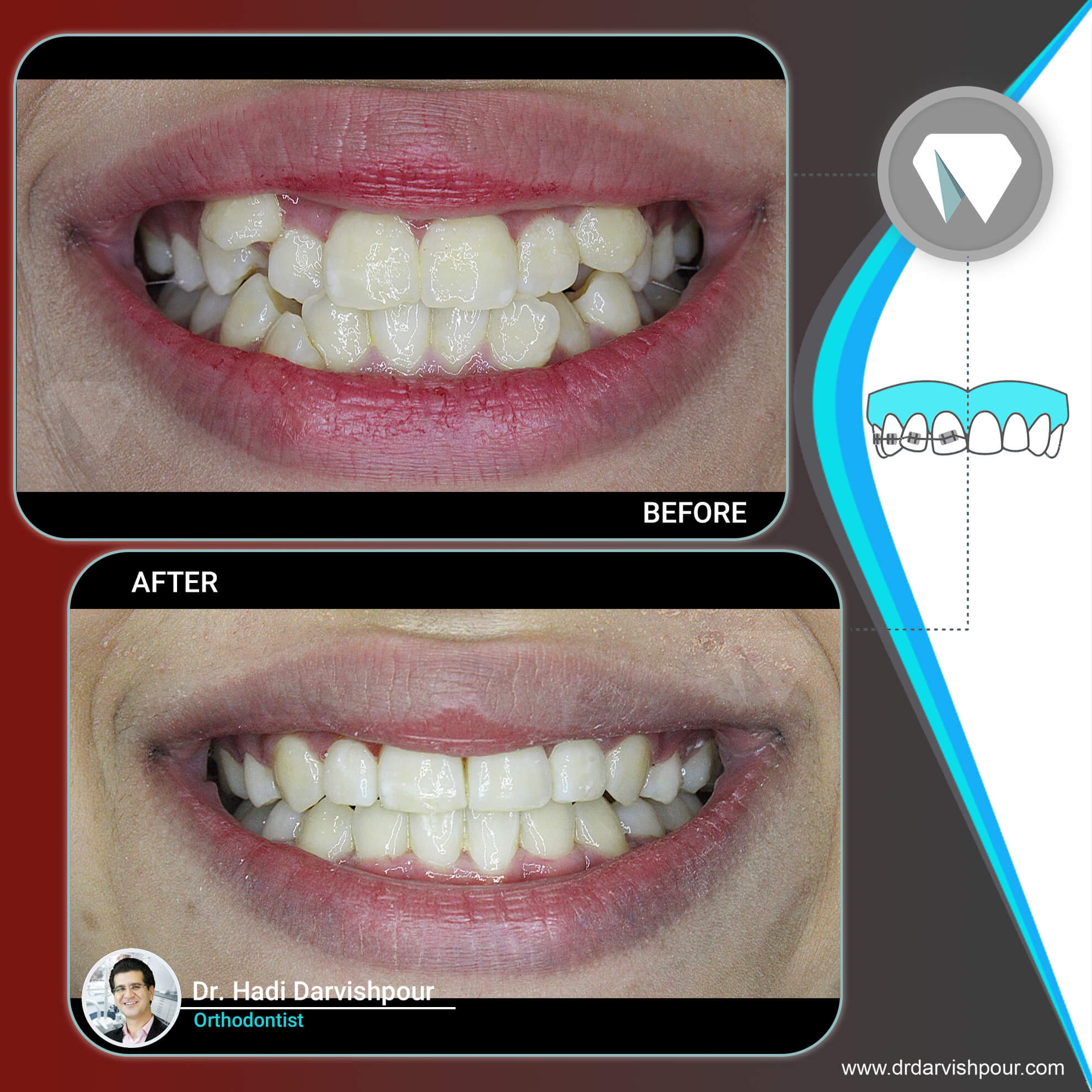 1767orthodontics-before-after-photo