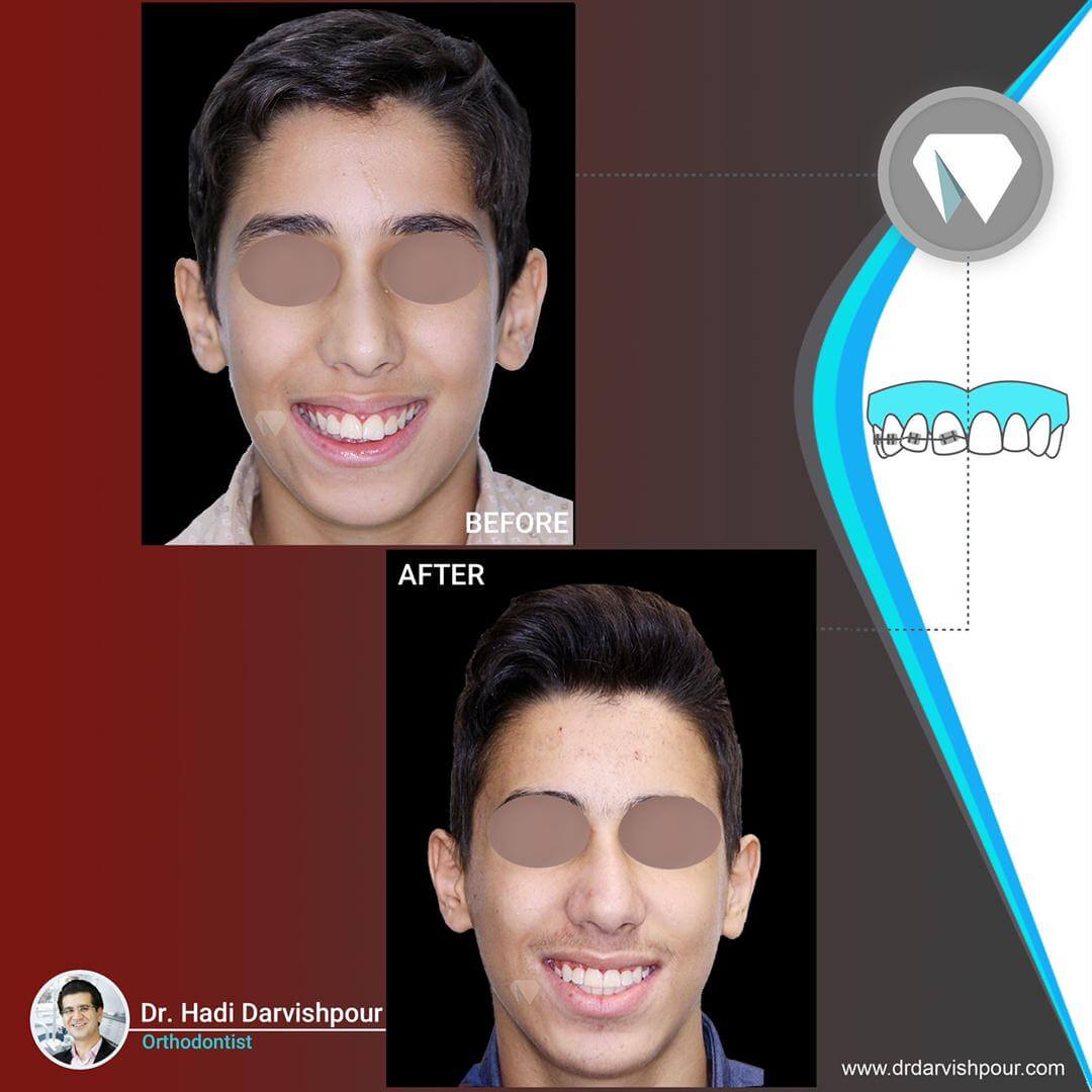 1770orthodontics-before-after-photo