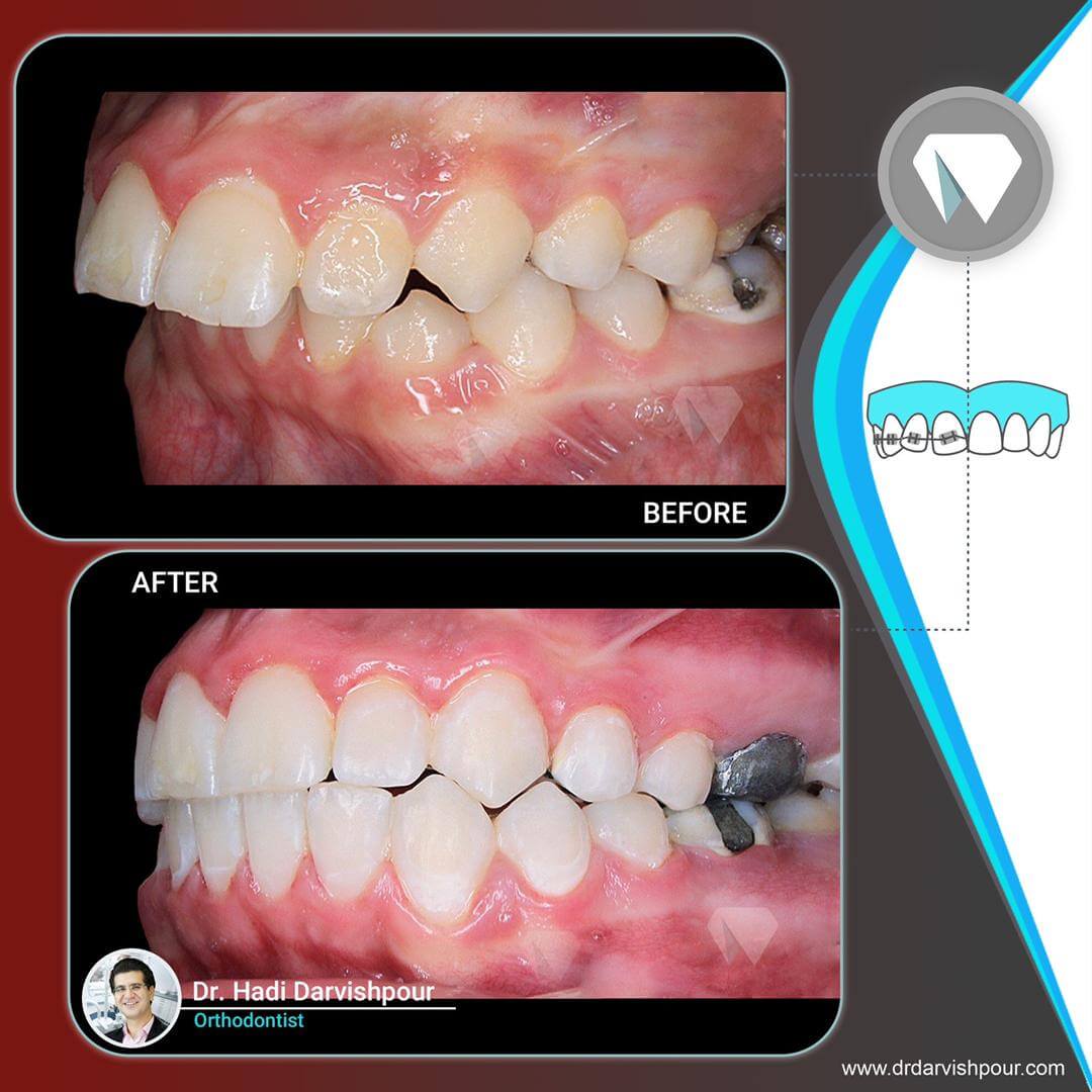 1771orthodontics-before-after-photo