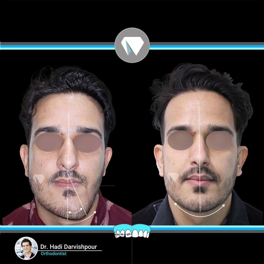 1773orthodontics-before-after-photo
