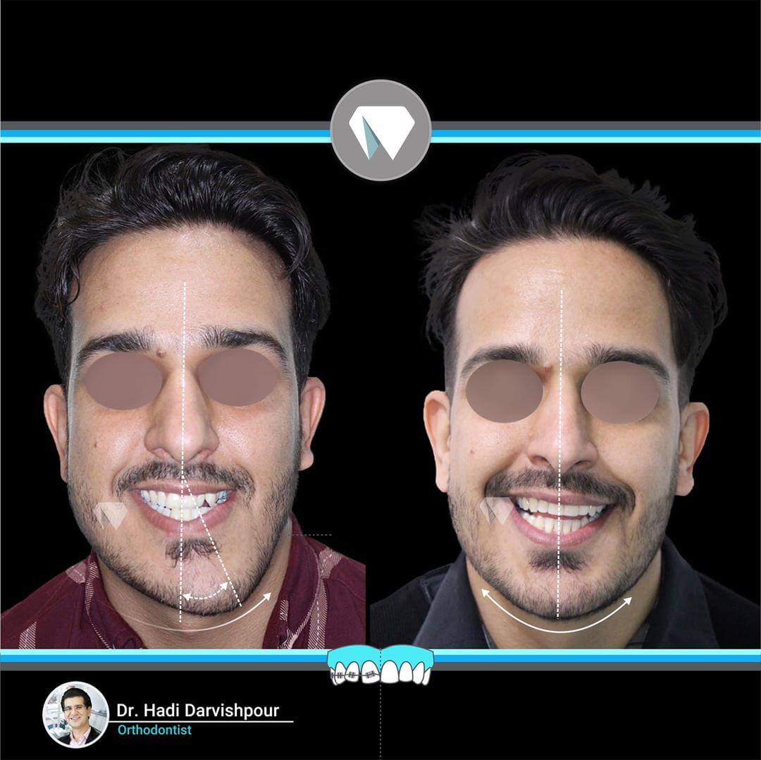 1774orthodontics-before-after-photo
