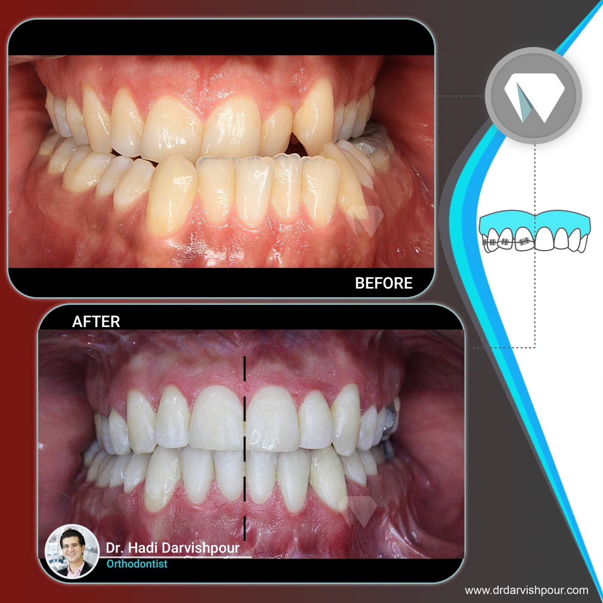 1775orthodontics-before-after-photo