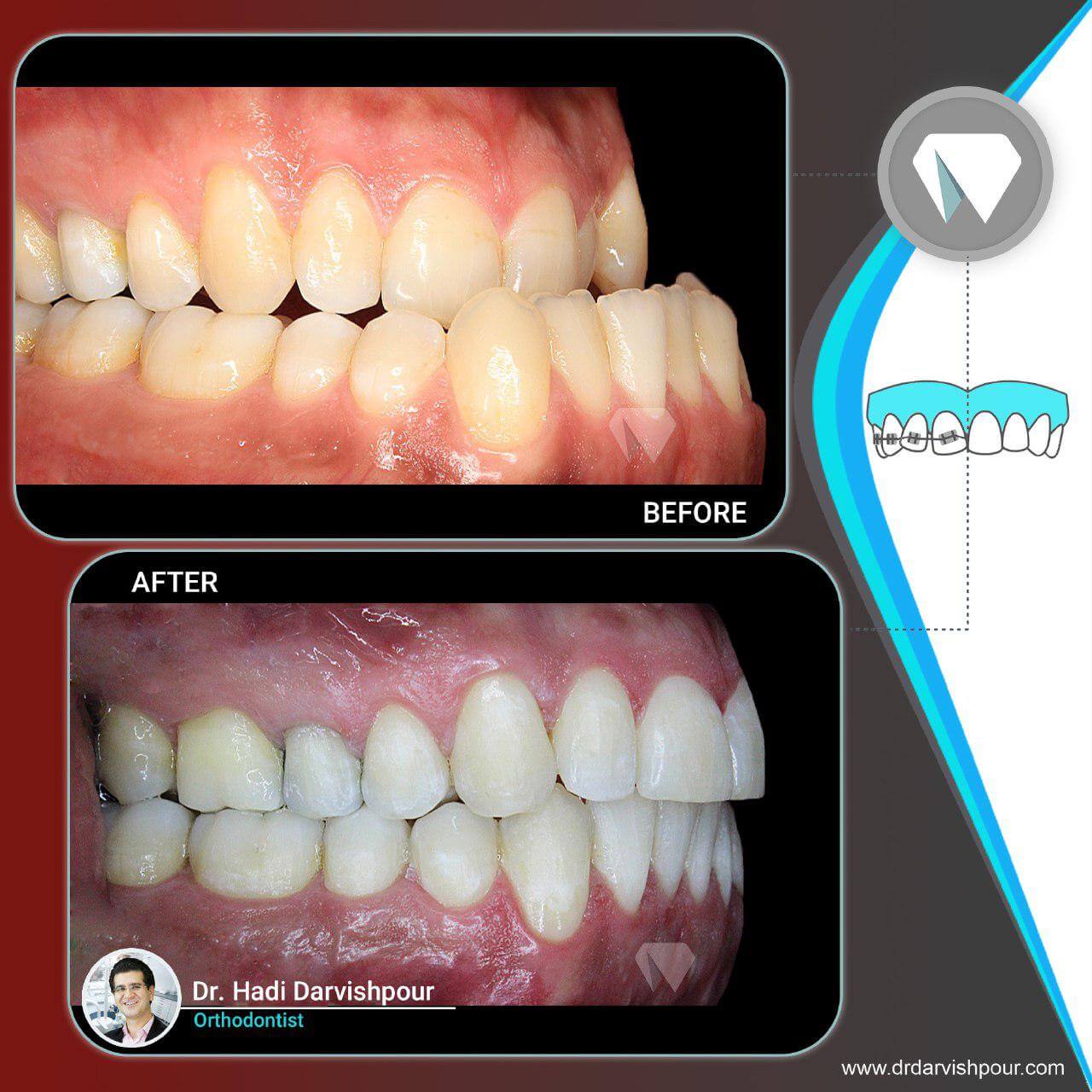 1776orthodontics-before-after-photo