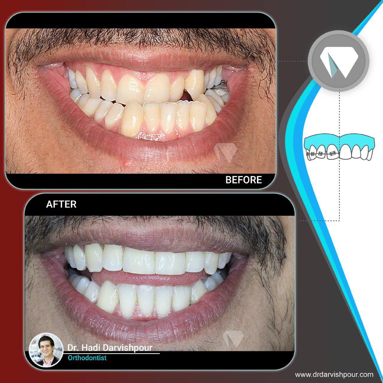 1777orthodontics-before-after-photo