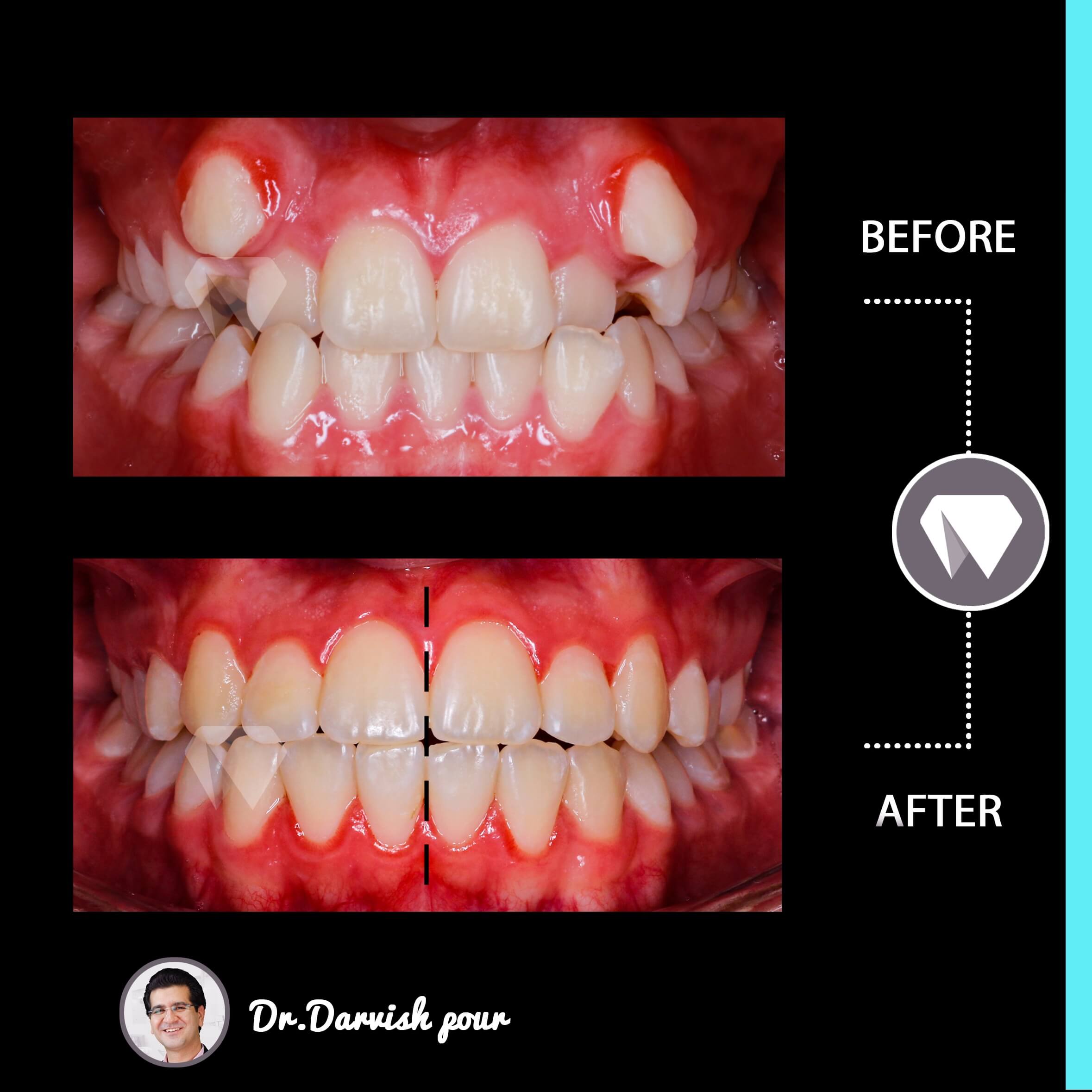 1779orthodontics-before-after-photo