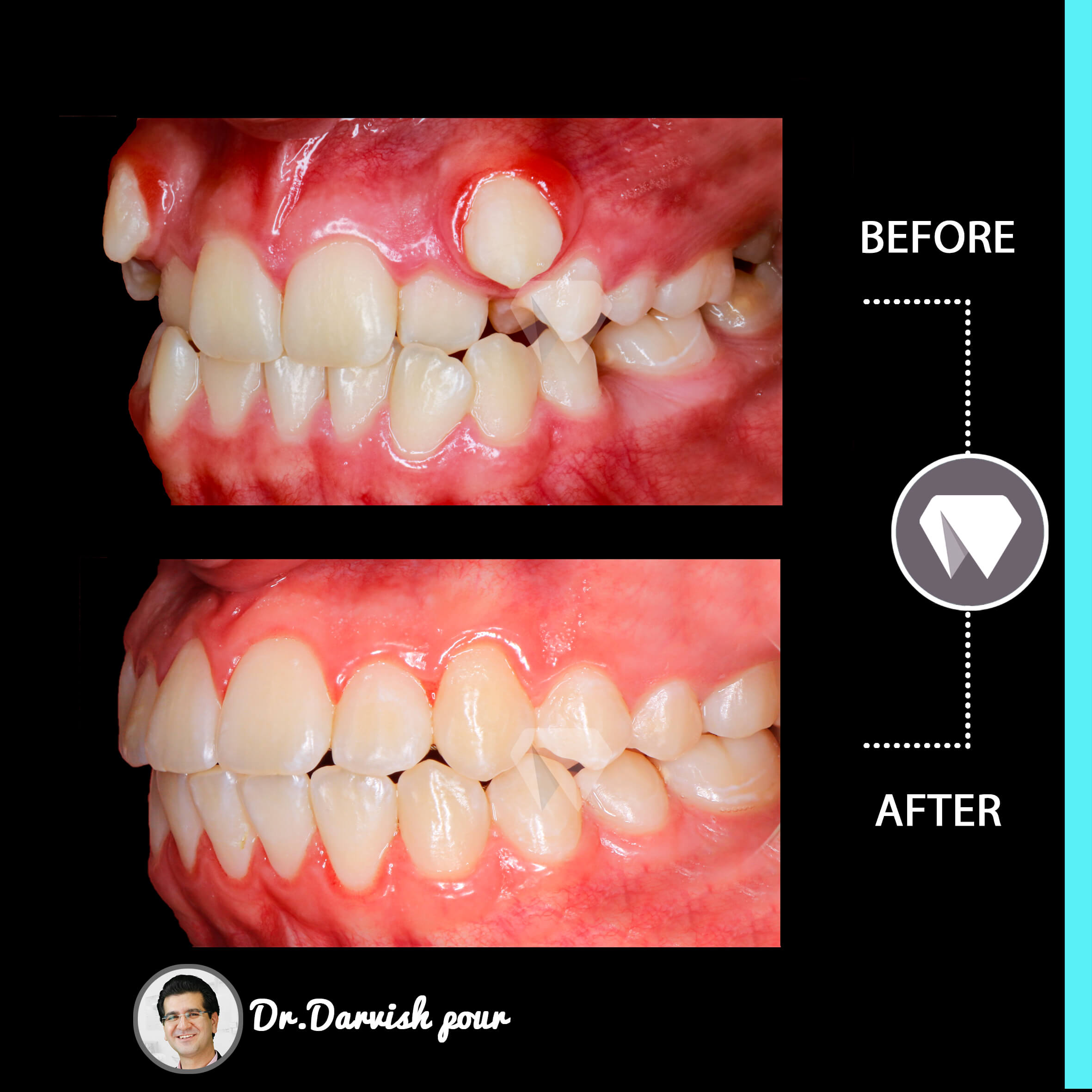 1780orthodontics-before-after-photo