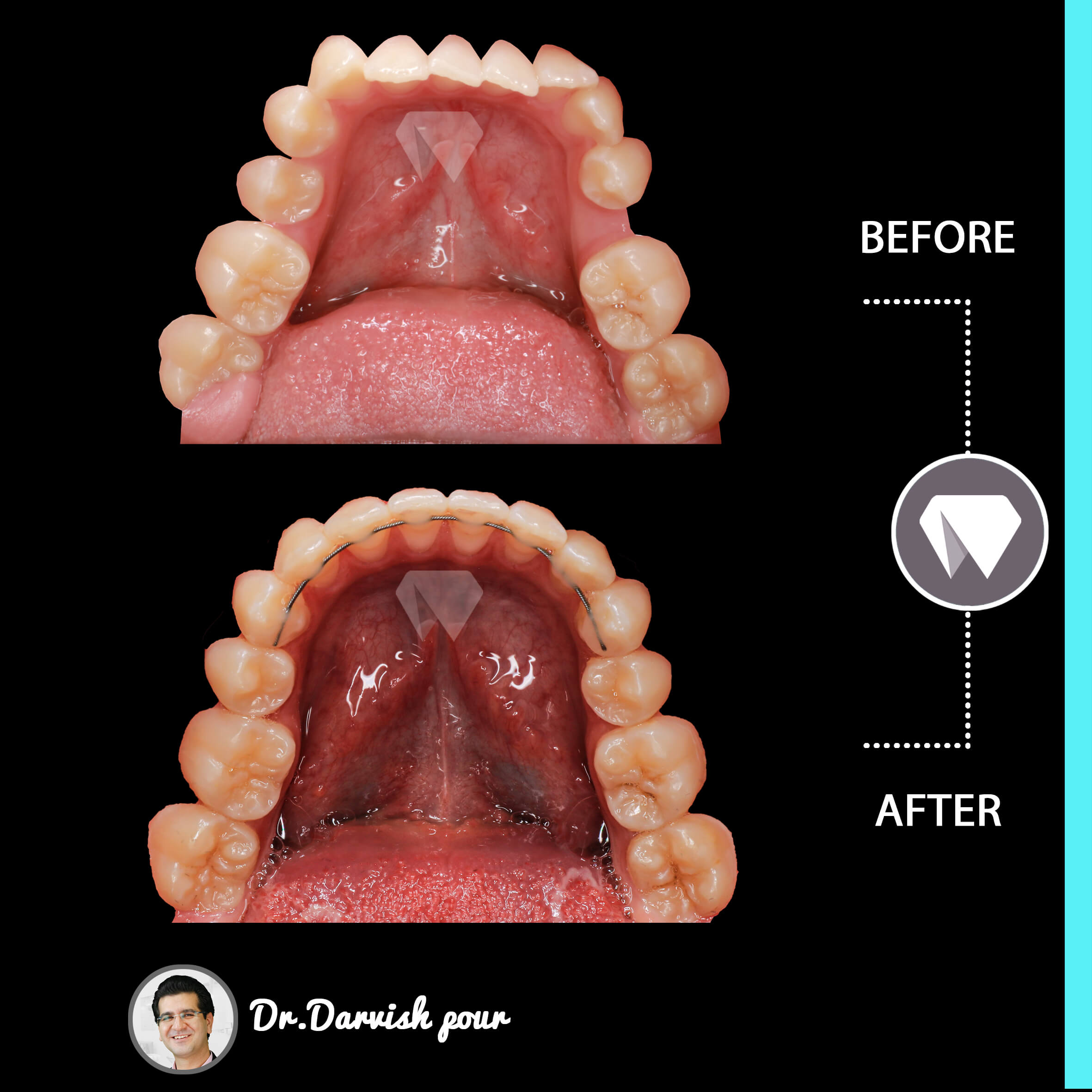 1782orthodontics-before-after-photo
