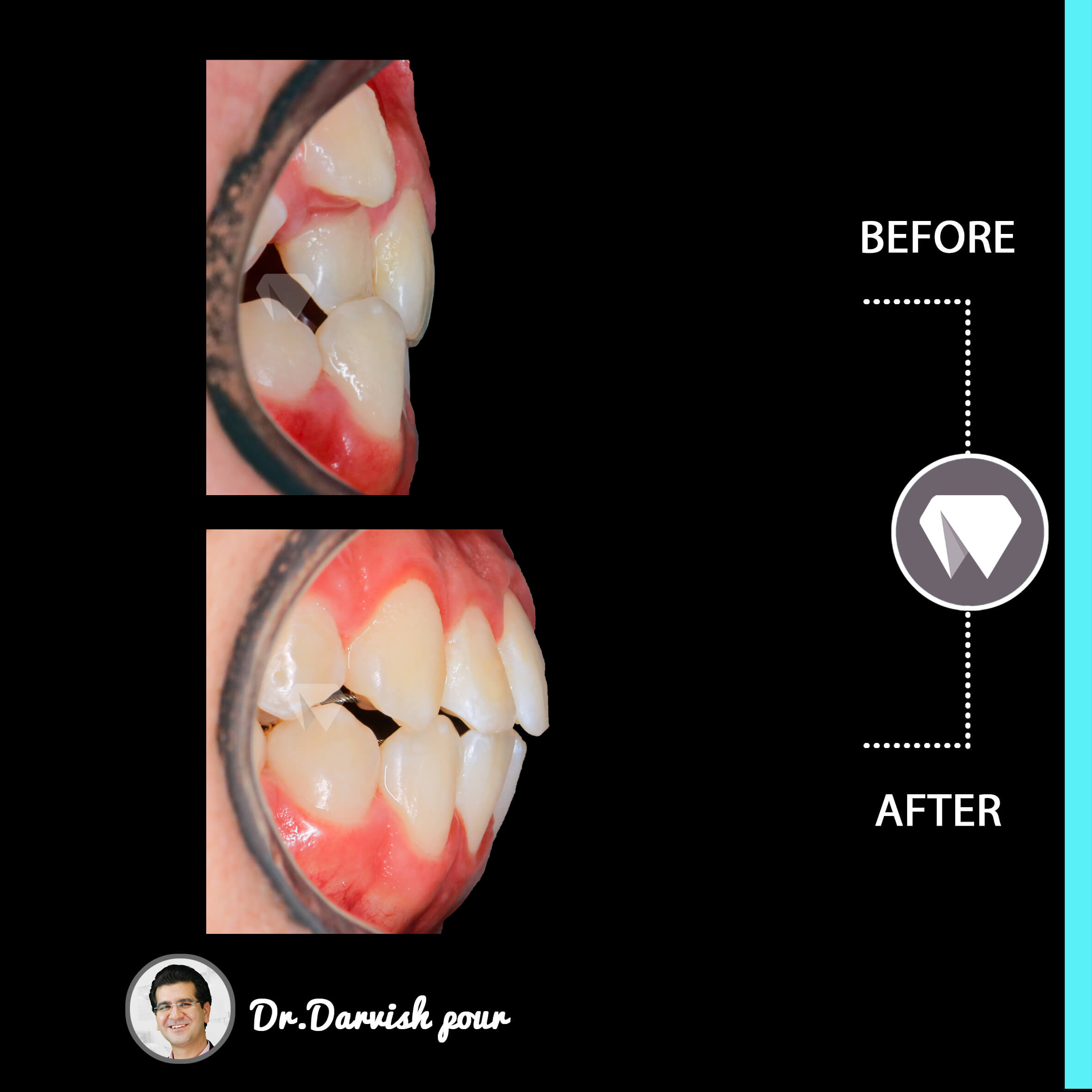 1784orthodontics-before-after-photo