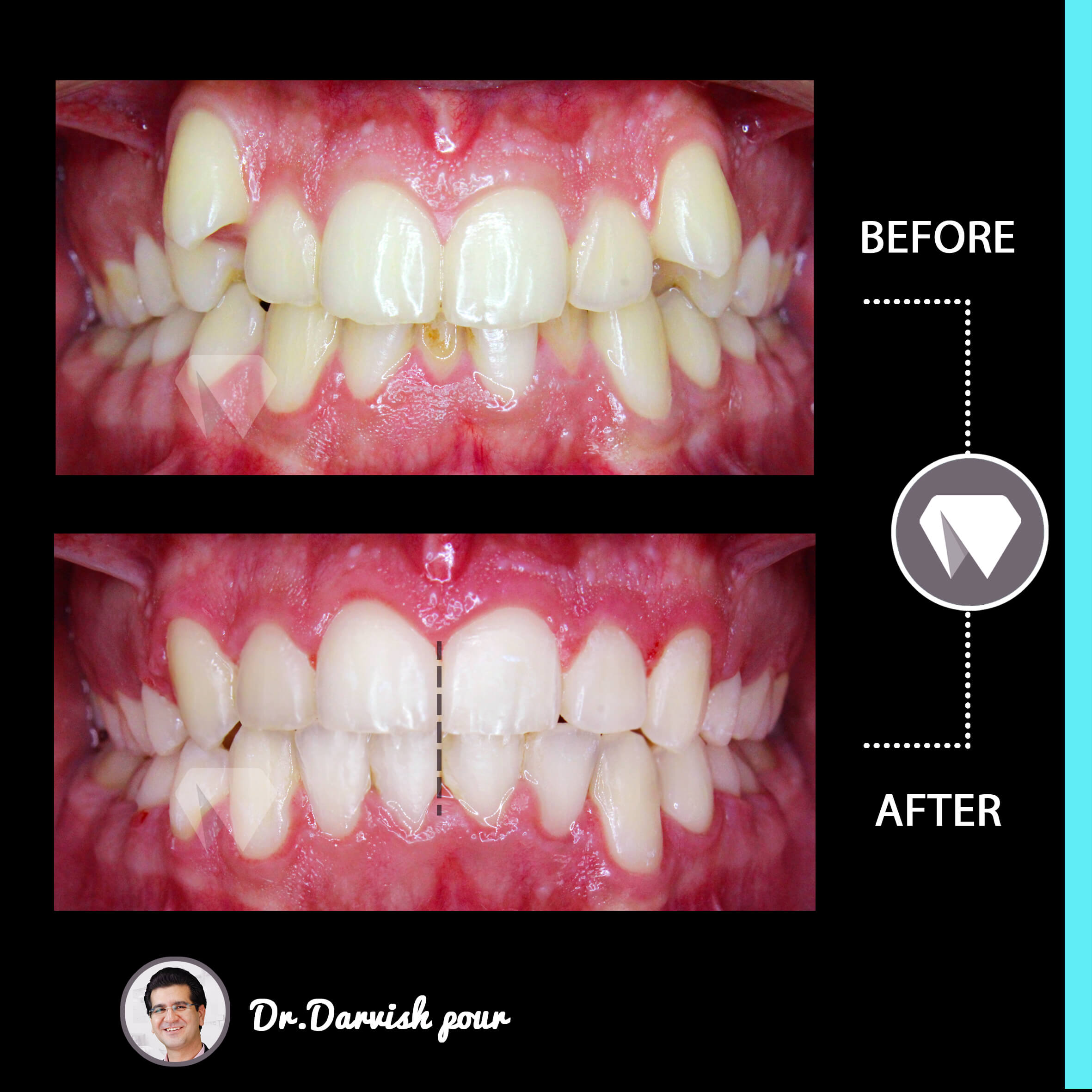 1786orthodontics-before-after-photo