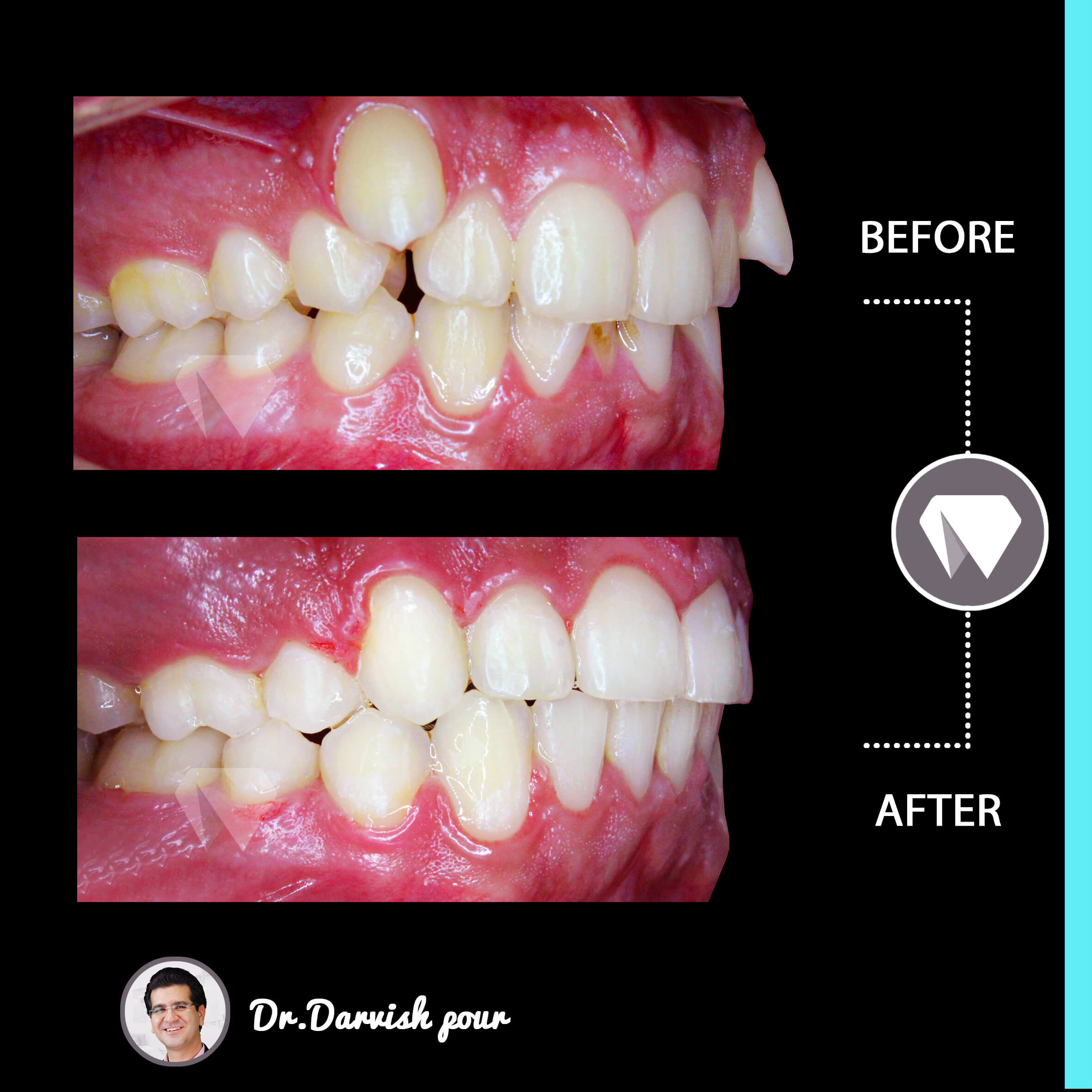 1787orthodontics-before-after-photo