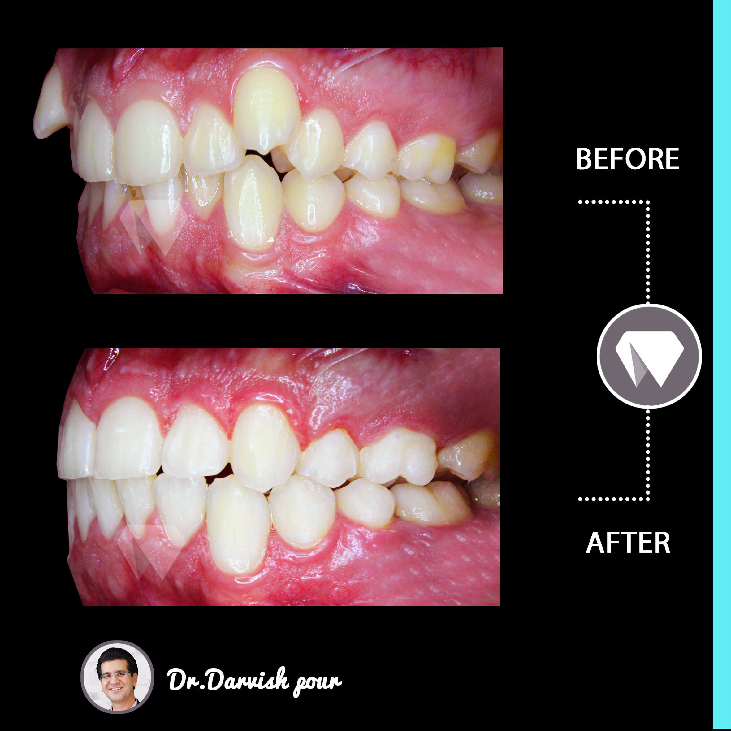 1788orthodontics-before-after-photo