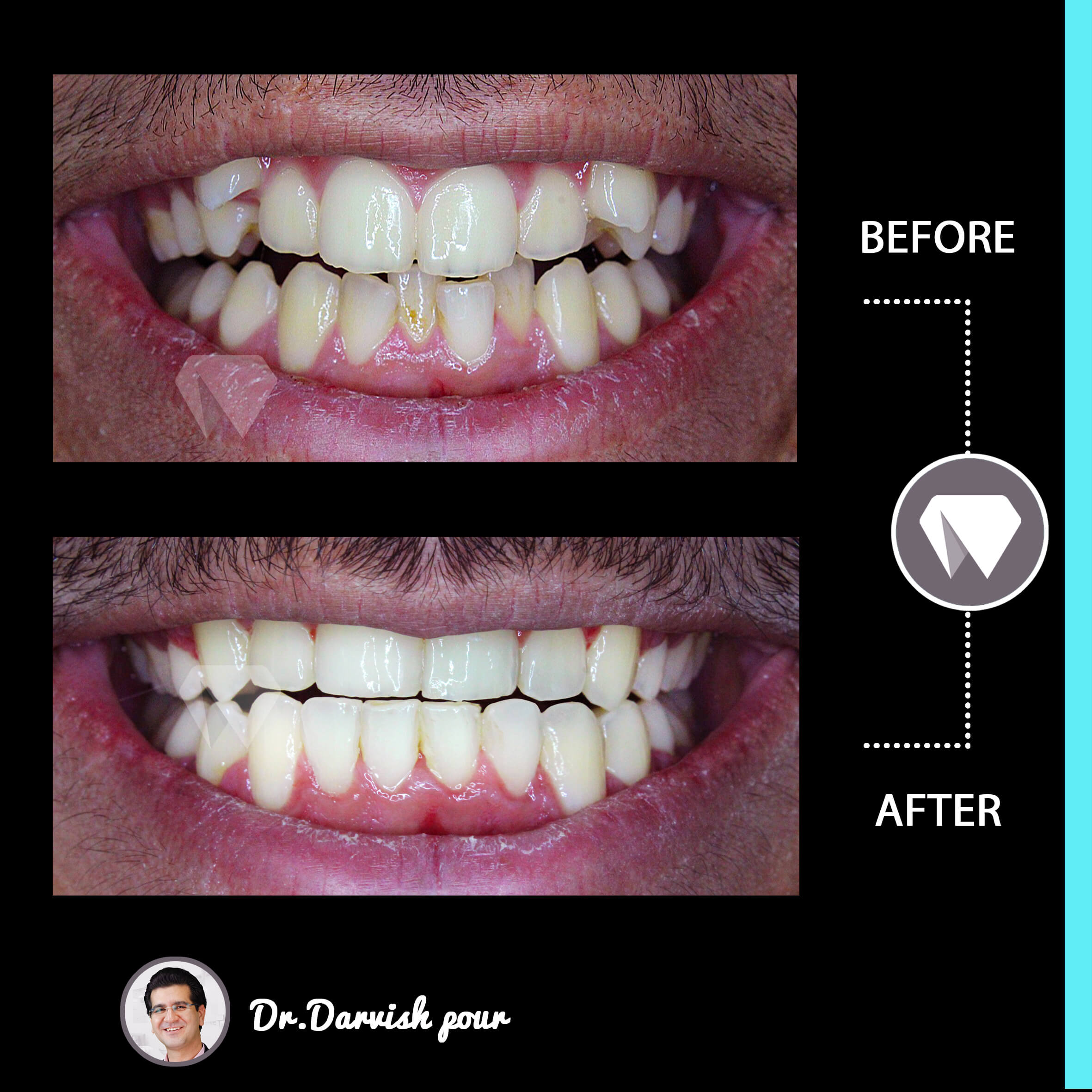 1789orthodontics-before-after-photo