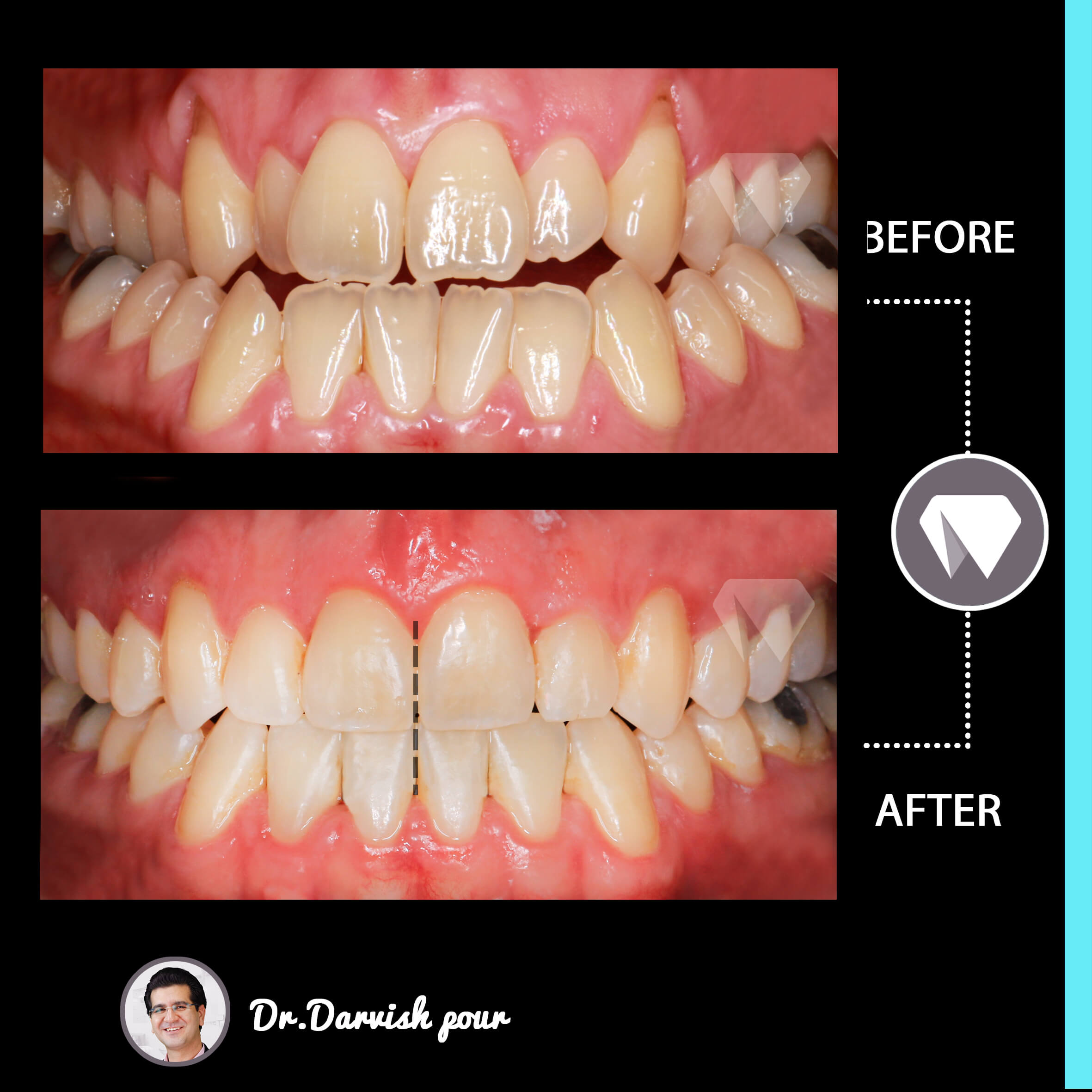 1791orthodontics-before-after-photo
