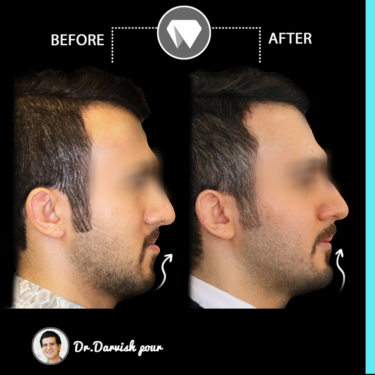 1792orthodontics-before-after-photo