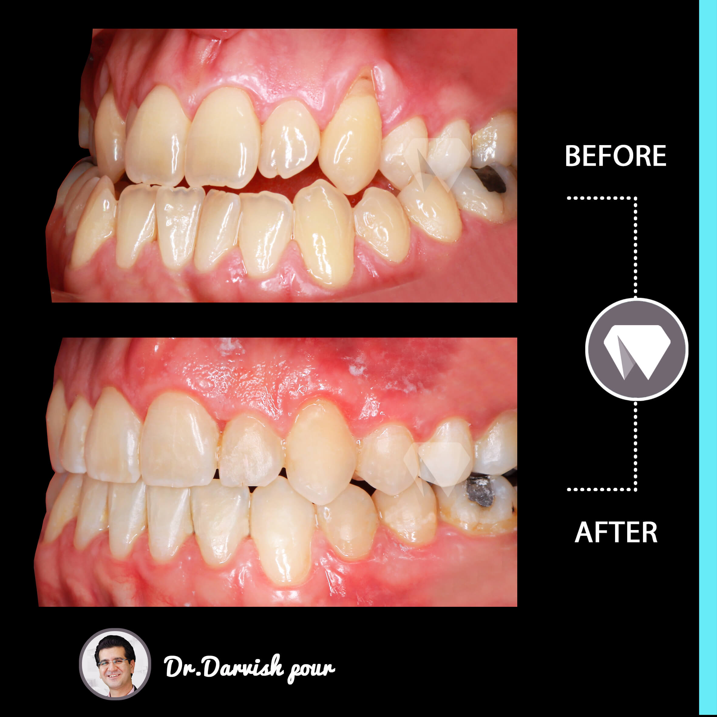 1793orthodontics-before-after-photo