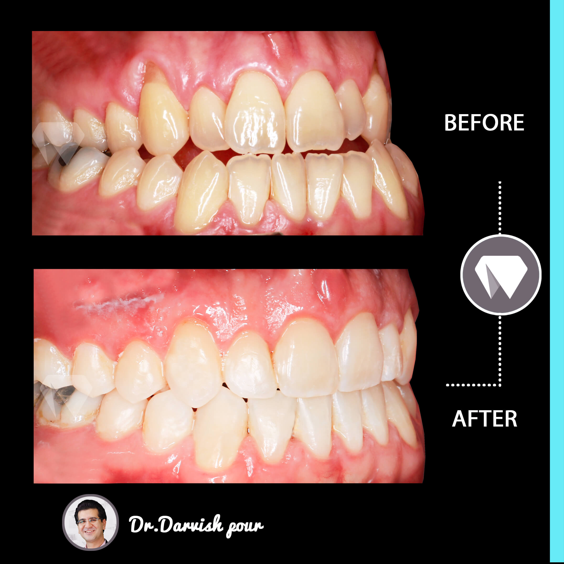 1794orthodontics-before-after-photo