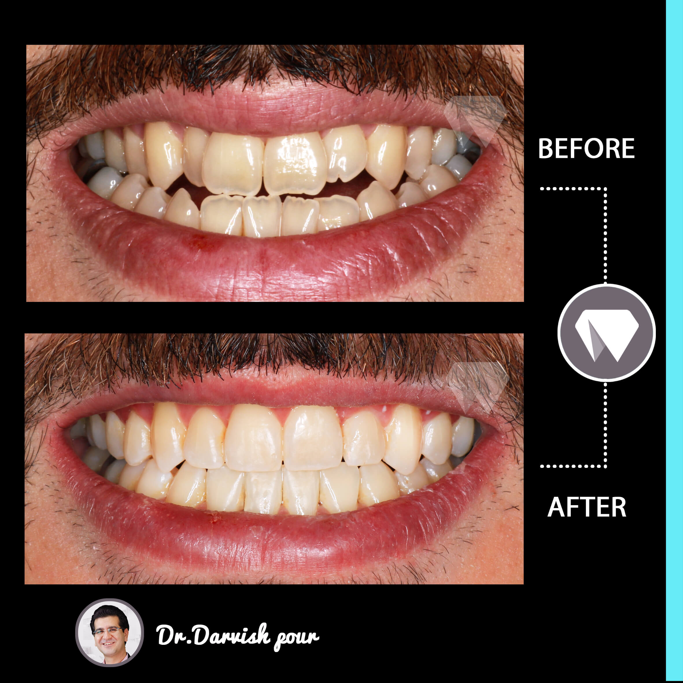 1795orthodontics-before-after-photo