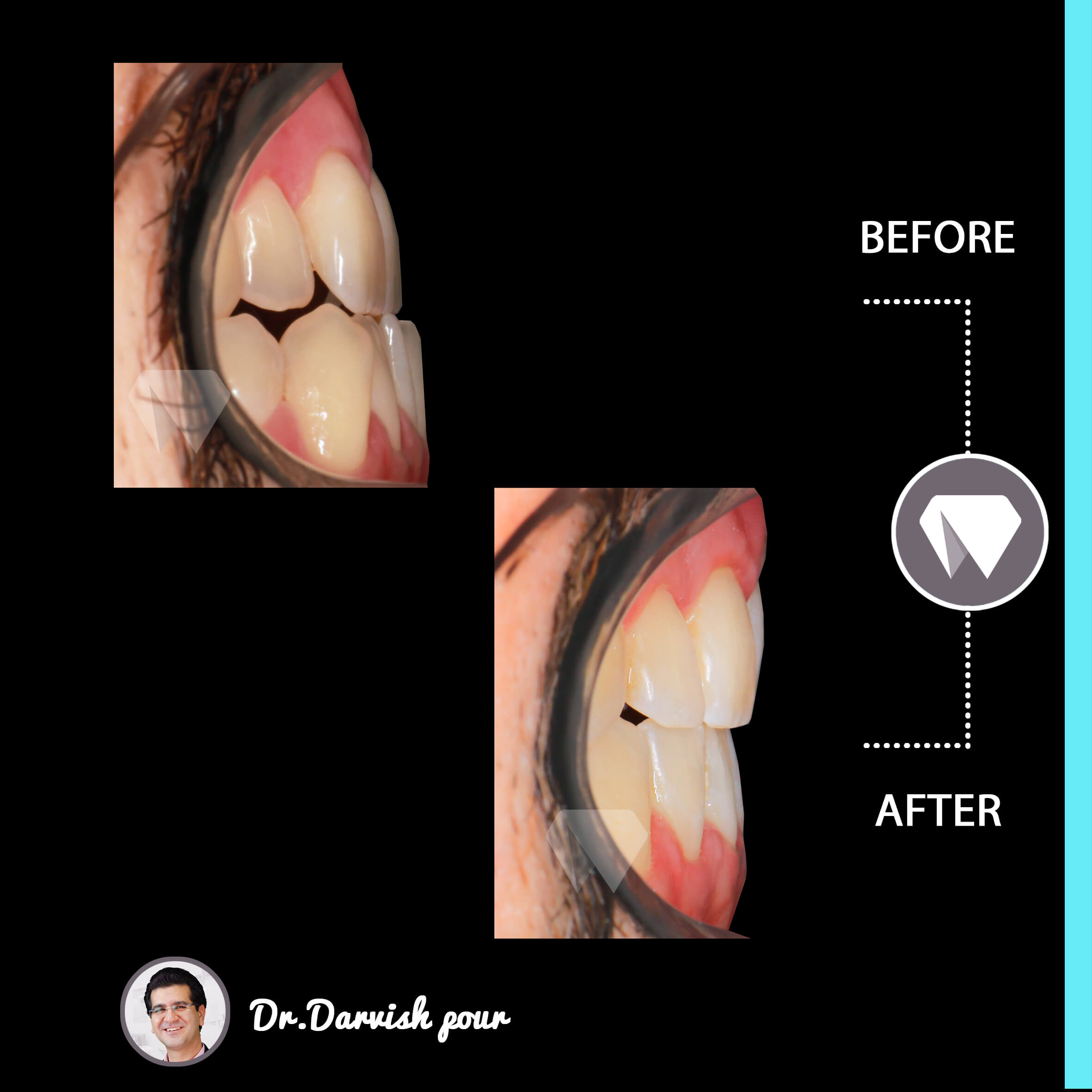 1796orthodontics-before-after-photo