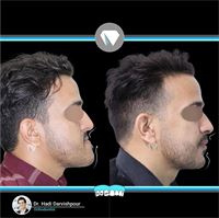 درمان ارتودنسی ثابت با جراحی فک و بدون کشیدن دندان