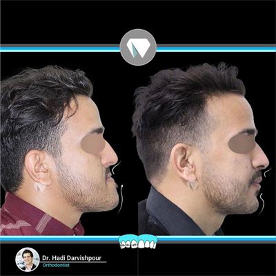 درمان ارتودنسی ثابت با جراحی فک و بدون کشیدن دندان