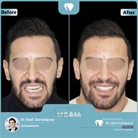 ارتودنسی همراه با جراحی فک