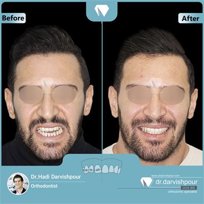 ارتودنسی همراه با جراحی فک