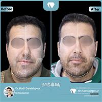 درمان ارتودنسی ثابت همراه با جراحی فک بدون کشیدن دندان