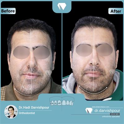 درمان ارتودنسی ثابت همراه با جراحی فک بدون کشیدن دندان