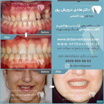 ارتودنسی ثابت دو فک دندان نهفته