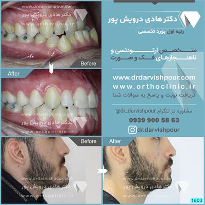 ارتودنسی همراه با جراحی فک