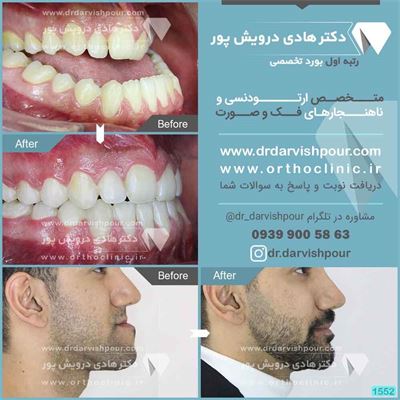 ارتودنسی به همراه جراحی فک
