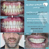 درمان ارتودنسی ثابت بدون جراحی فک و بدون کشیدن دندان