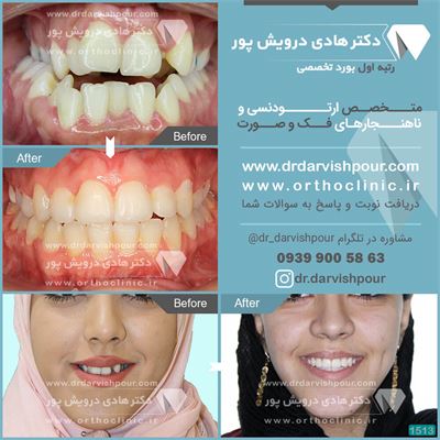 درمان ارتودنسی ثابت همراه با جراحی فک با کشیدن دندان
