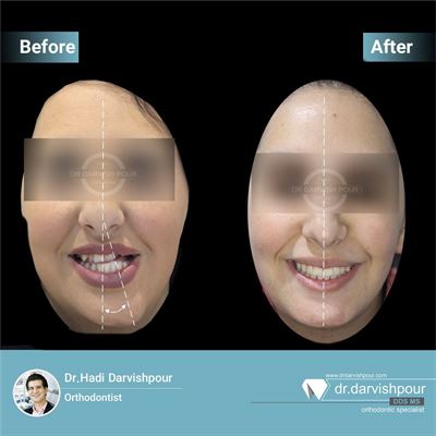 ارتودنسی به همراه جراحی فک