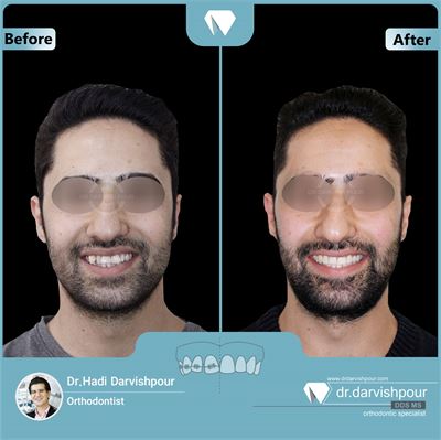 درمان ارتودنسی ثابت دو فک همراه با کشیدن دندان 