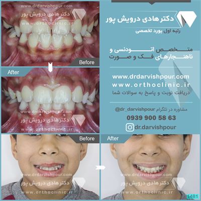 ارتودنسی متحرک بدون جراحی فک و بدون کشیدن دندان
