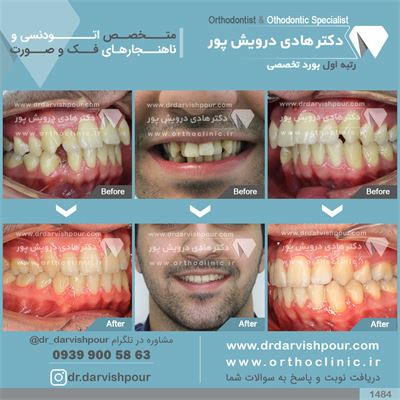  ارتودنسی ثابت همراه با کشیدن دندان