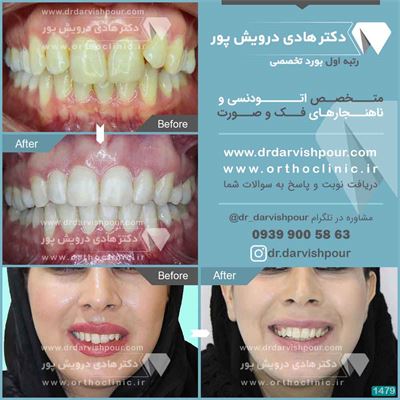 ارتودنسی ثابت دو فک همراه با کشیدن دندان